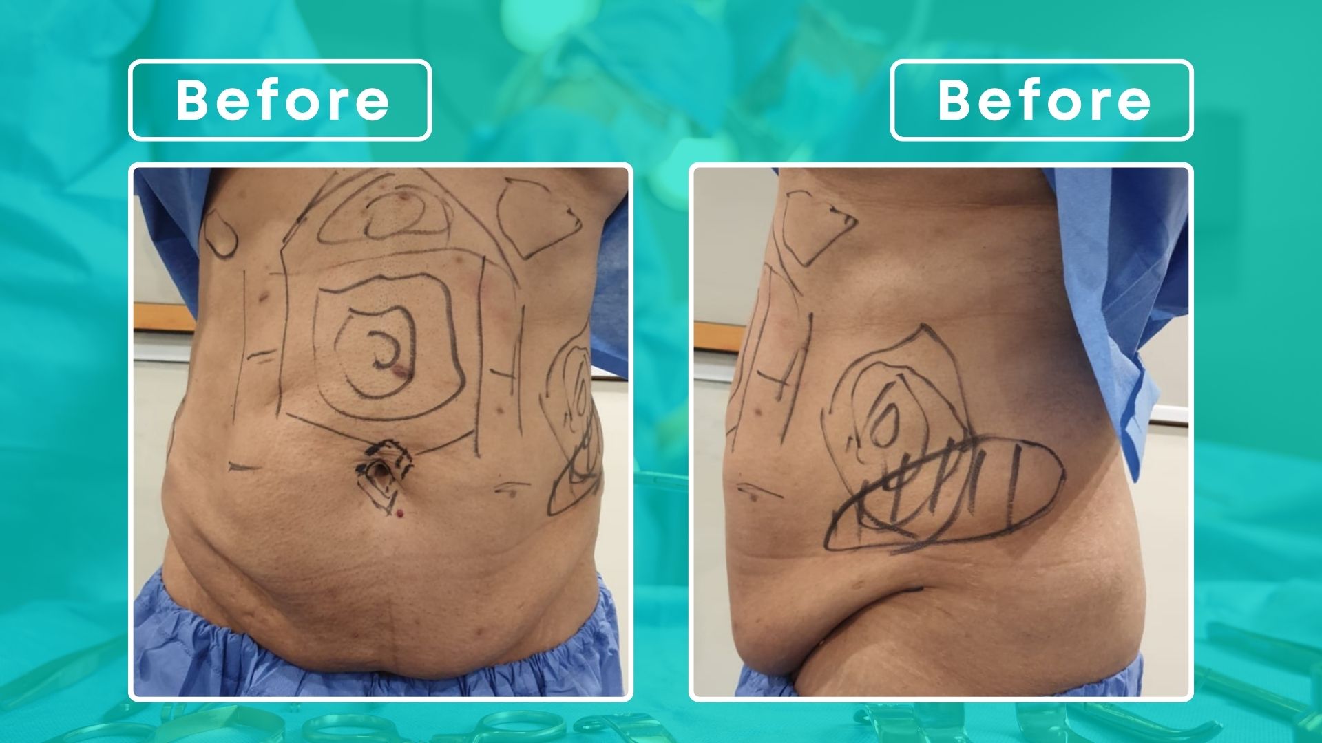 Abdominoplasty & Liposuction image (1)