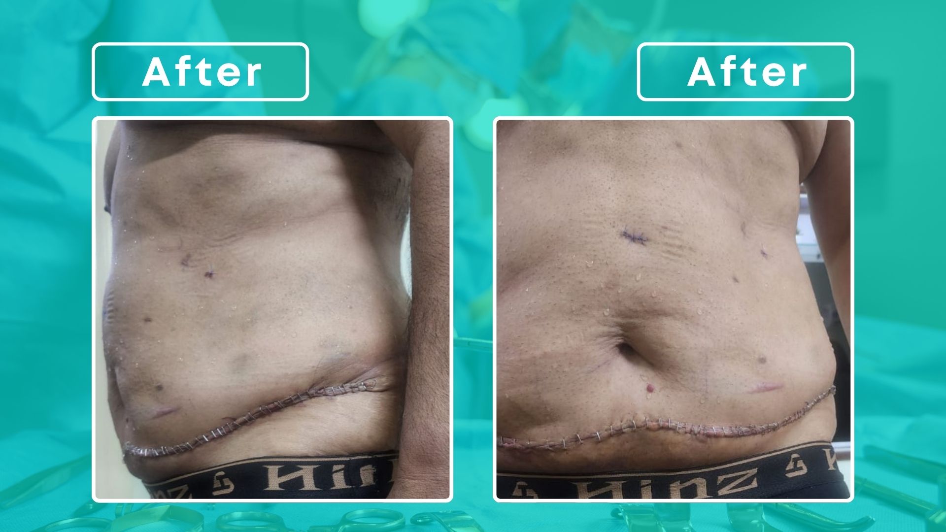 Abdominoplasty & Liposuction image (2)