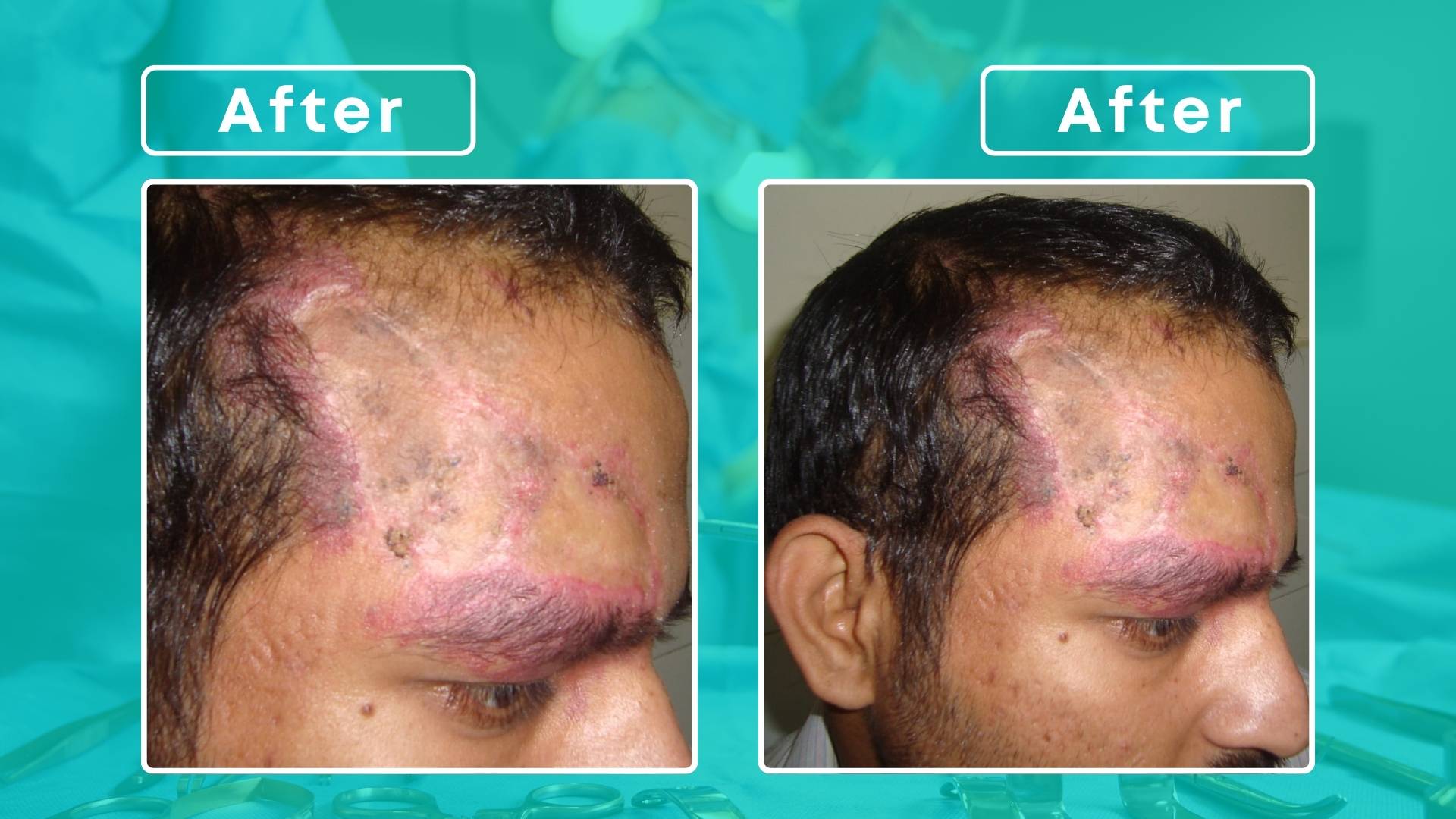 Vascular Malformation Forehead (1)